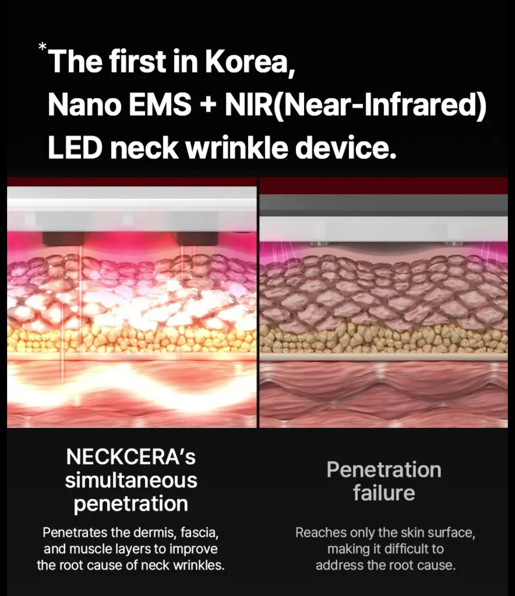 BEAUND NECERA | 목주름 개선