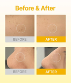 ACROPASS DARK SPOT CARE MICROCONE PATCH | 미백 관리 패치(6P)