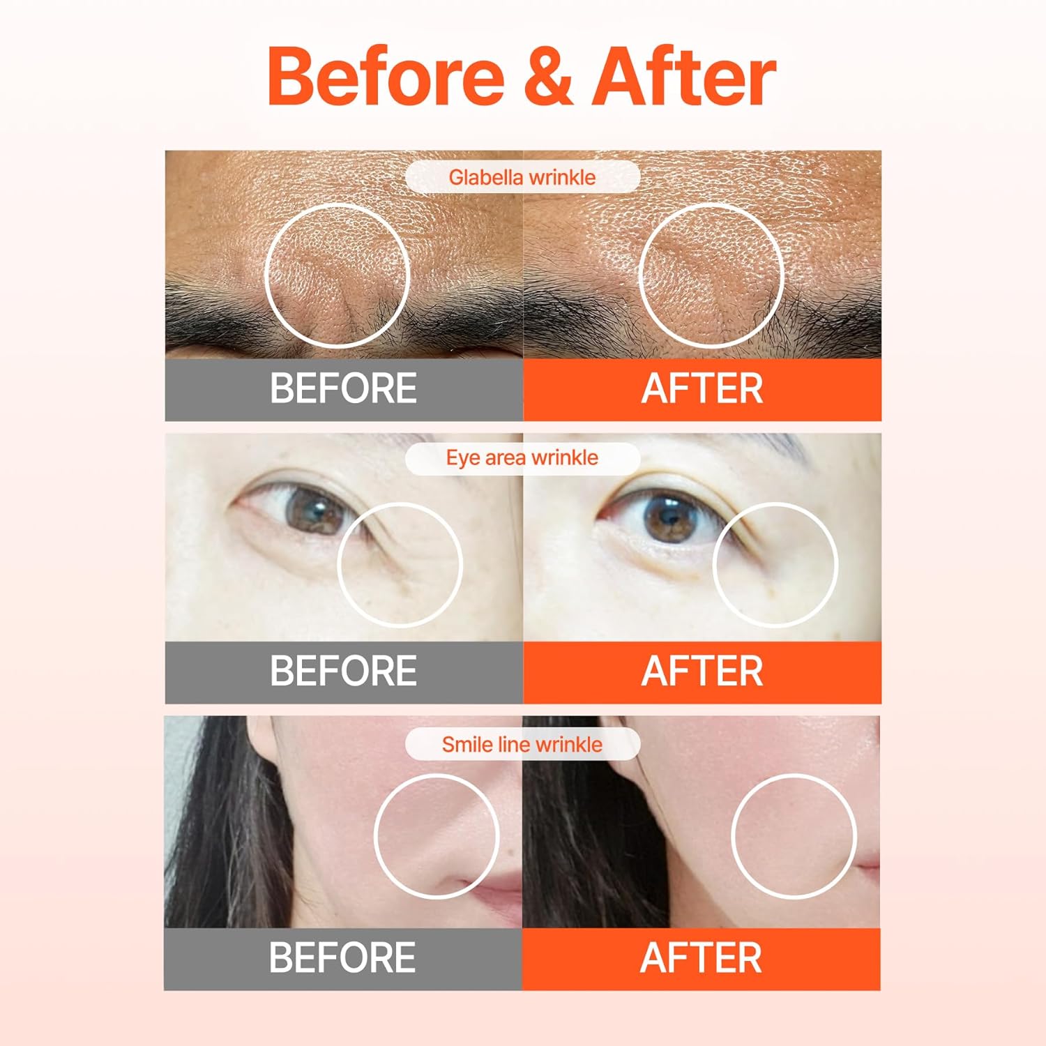 ACROPASS RETI-RN WRINKLE CARE MICROCONE PATCH | 주름 관리 패치(6P)