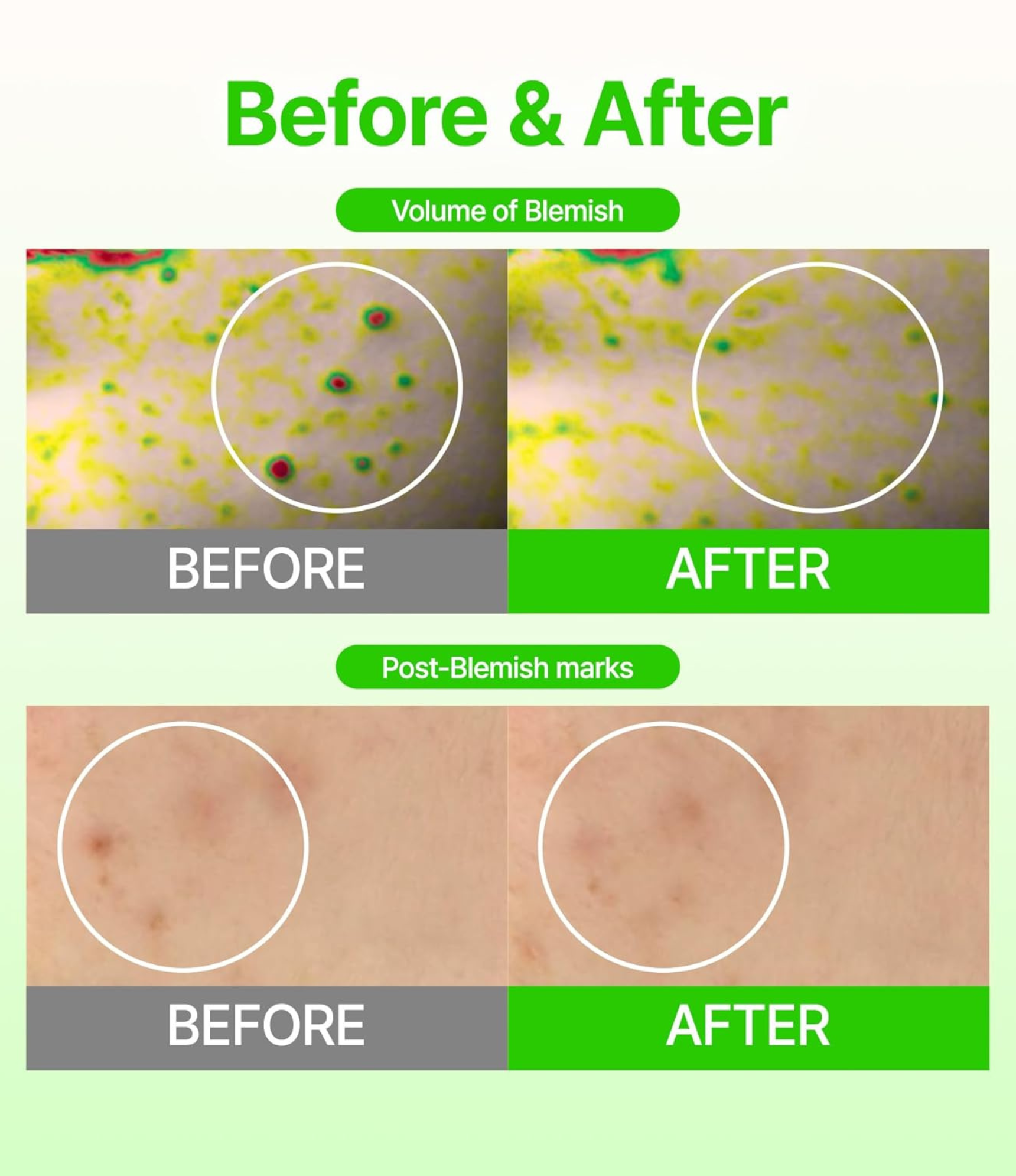 ACROPASS BLEMISH CARE MICROCONE PATCH | 여드름 자국 관리 패치(8P)